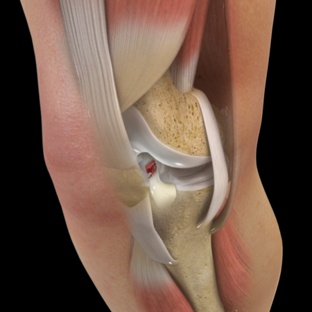 Ligament sprains and meniscus tears