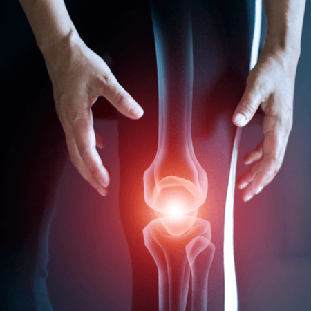 Osteoarthritis and joint degeneration